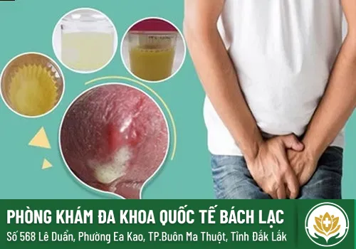 Vì sao tiểu buốt sau khi quan hệ - Tìm hiểu cùng chuyên gia